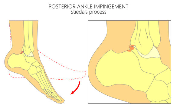 Posterior ankle impingement. Stieda process