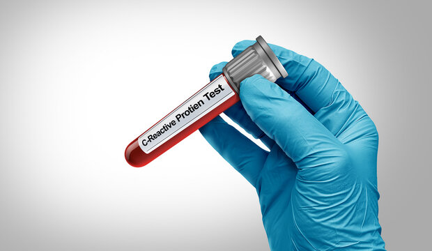 C-Reactive Protein Test as a doctor holds a blood test showing a blood vial with a result used to assess inflammation diagnosis and infection indicator..
