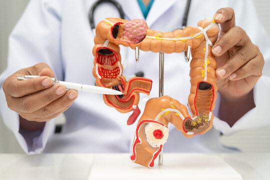 Colorectal cancer, doctor holding intestine colon human anatomy model.