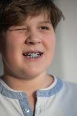 Close-up of teenage boy smiling with dental braces. Concept of orthodontic treatment, dental care, healthy teeth, modern dentistry and adolescence.
