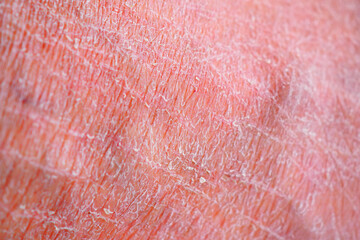 Skin surface showing dryness and texture changes in detail