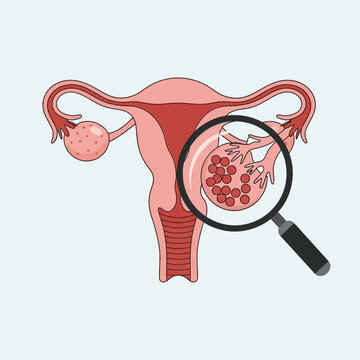 Uterus and ovaries with enlarged view of fibroid tumor under magnifying glass
