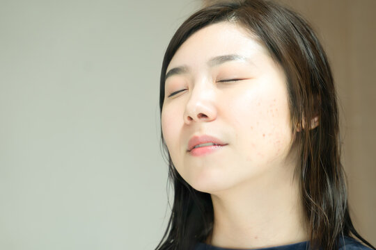 頬にシミや瘡蓋がある女性