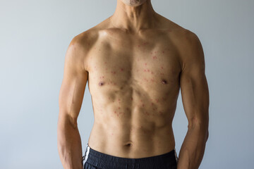 Obraz premium Man torso showing red rash skin condition