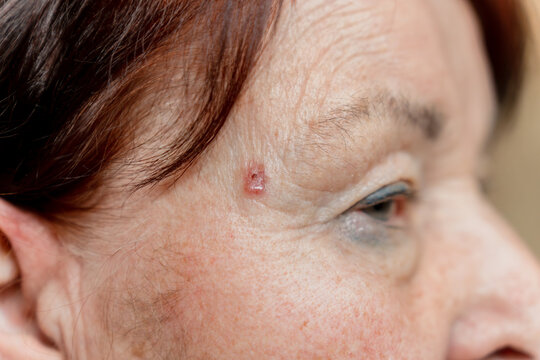 Basal cell carcinoma on the temple of an elderly woman. Saint Petersburg, Russia - 17 Jan 2026