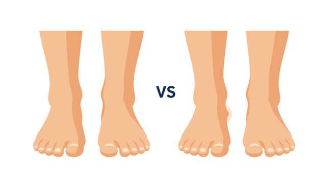 Comparison between healthy feet and swollen feet with edema, illustrating a medical condition or symptom of fluid retention.