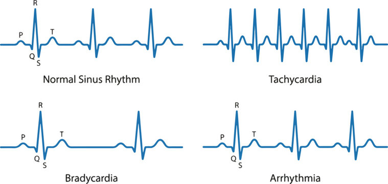 2026 Medical Illustration of Human Heartbeat Rhythms: Normal Sinus, Tachycardia, Bradycardia, and Arrhythmia ECG Lines on White Background