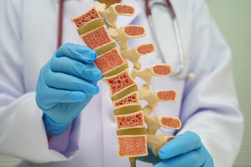 Doctor holding osteoporosis in back bone model for treatment medical in orthopedic department.