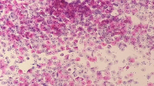 Photomicrographic footage of Paps smear: Inflammatory smear with koilocytosis suggestive of HPV infection. Cervical cancer. SCC