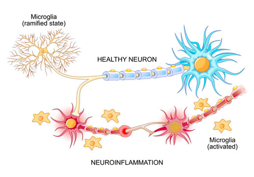 Neuroinflammation. Healthy neuron and unhealthy nerve cell. Microglia before and after activation