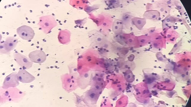 Photomicrographic footage of Paps smear: Inflammatory smear with koilocytosis suggestive of HPV infection. Cervical cancer. SCC