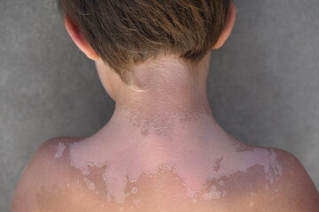 Vitiligo skin disease in a child