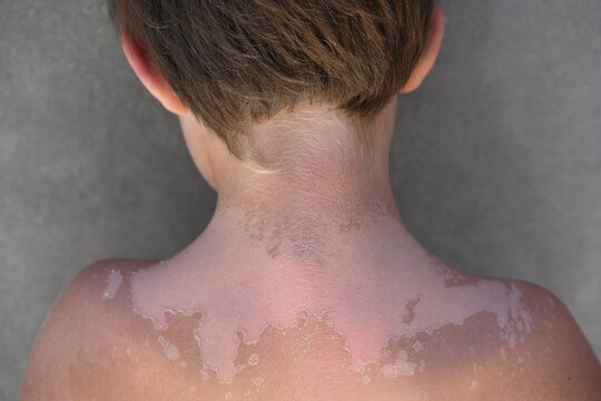 Vitiligo skin disease in a child