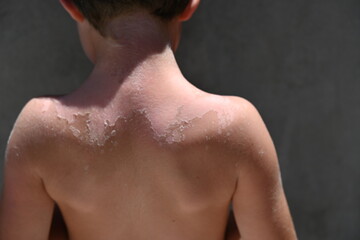Naklejka premium Vitiligo skin disease in a child