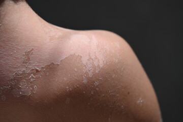 Vitiligo skin disease in a child