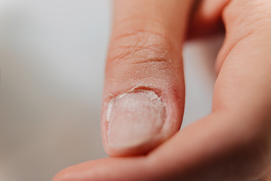 Closeup of a damaged fingernail with dry skin and white flakes, showing signs of fungal infection or irritation.