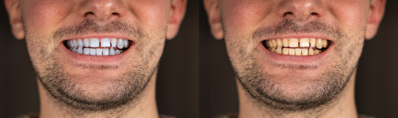 Obraz premium Un avant après blanchiment dentaire avec d'un côté, les dents jaunes et de l'autre, les dents blanches.