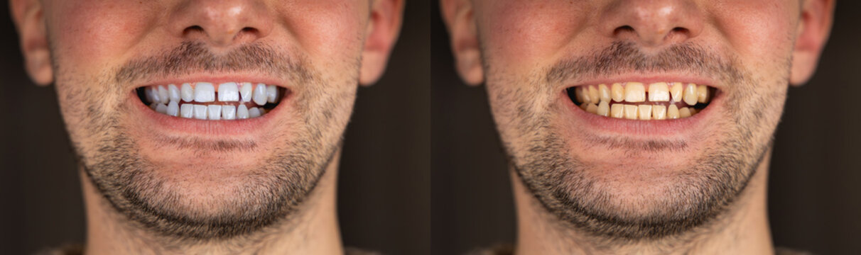 Un avant apr&egrave;s blanchiment dentaire avec d'un c&ocirc;t&eacute;, les dents jaunes et de l'autre, les dents blanches.