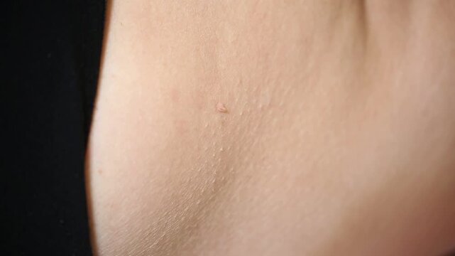 Extreme close up view of a small skin tag or papilloma on human skin. Detailed texture of the dermis with pores and fine hair visible near black clothing.


