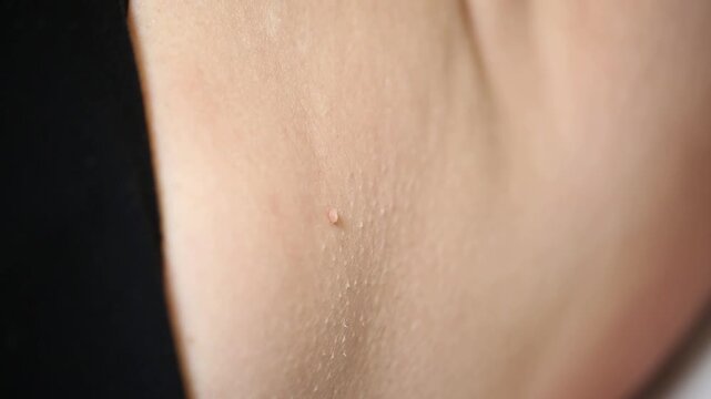 Extreme close up view of a small skin tag or papilloma on human skin. Detailed texture of the dermis with pores and fine hair visible near black clothing.

