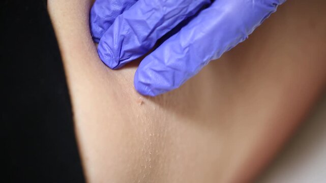 Extreme close up view of a small skin tag or papilloma on human skin. Detailed texture of the dermis with pores and fine hair visible near black clothing.

