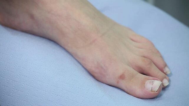 Close-up of a bare foot showing a metal wire brace on the big toenail, a podiatry treatment for correcting ingrown nails known as orthonyxia, resting on blue paper.

