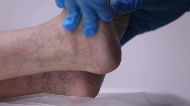 Close-up of doctor's hands in blue gloves examining foot of elderly patient with visible spider veins and varicose veins during a routine medical checkup in a clinic.

