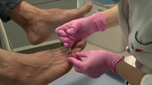 Close up of a podiatrist in pink gloves carefully removing dead skin from a patient's toe wound using scissors during a medical foot care procedure.

