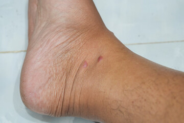 Naklejka premium Close-up of two small red spots or skin lesions on a person's ankle. Concept of dermatology, skin allergy, insect bites, or medical condition.