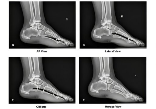 X-ray series showing right ankle distal fibula fracture for medical diagnosis