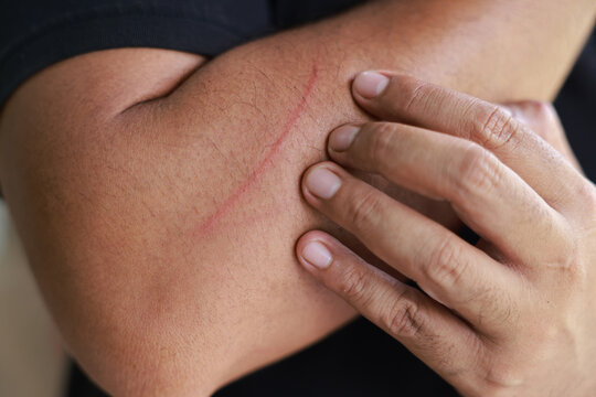 Close-up of man hand holding arm with scratch skin wound and red bruise from tree branch. Concept of accidental injury, skin abrasion, first aid, and physical pain in outdoor lifestyle.
