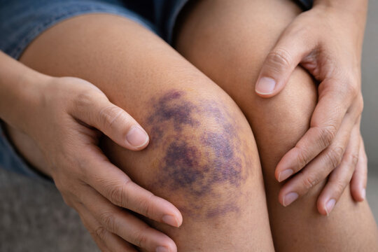 Close up of stain bruise wound on leg, contusion asian young woman, girl on joint knee from an accident fell down, hand in healing injury by massage hematoma blood. Extravasation blue, purple on skin.
