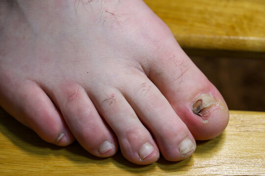 A male foot featuring a close-up of a damaged big toe nail with signs of fungal infection or an old hematoma. This detailed view shows nail plate deformation and discoloration,