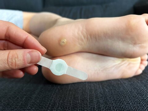 Hand holding a medicated patch near a plantar wart on a child&rsquo;s foot, representing home treatment and foot care practice