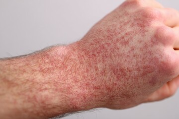 Psoriasis is a skin related autoimmune condition