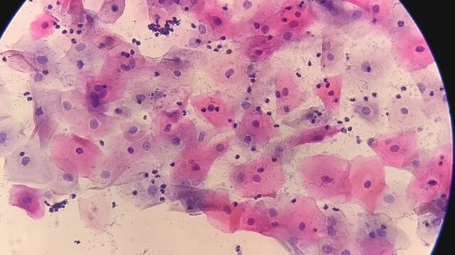 Photomicrographic footage of Paps smear: Inflammatory smear with koilocytosis suggestive of HPV infection. Cervical cancer. SCC