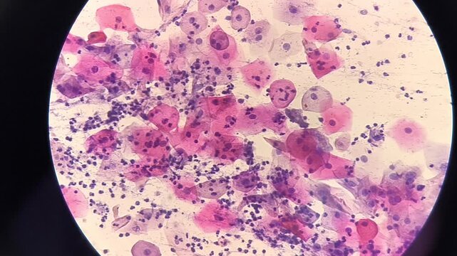 Photomicrographic footage of Paps smear: Inflammatory smear with koilocytosis suggestive of HPV infection. Cervical cancer. SCC