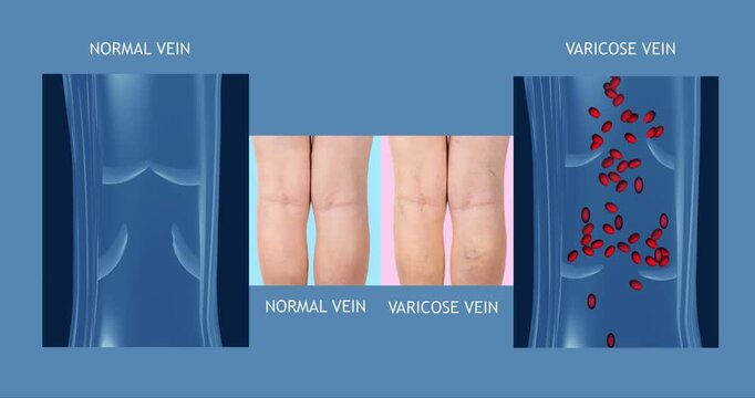 Varicose veins on a female senior legs. The structure of normal and varicose veins. Concept of dry skin, old senior people, varicose veins and deep vein thrombosis or DVT - 2D animation