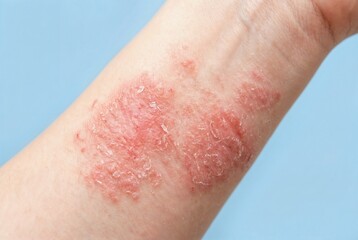 Fototapeta premium Close-up of eczema on an adult's forearm with irritated, red, dry skin