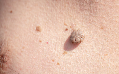 Nevus close-up. Mole on human skin. Irregular birthmark.