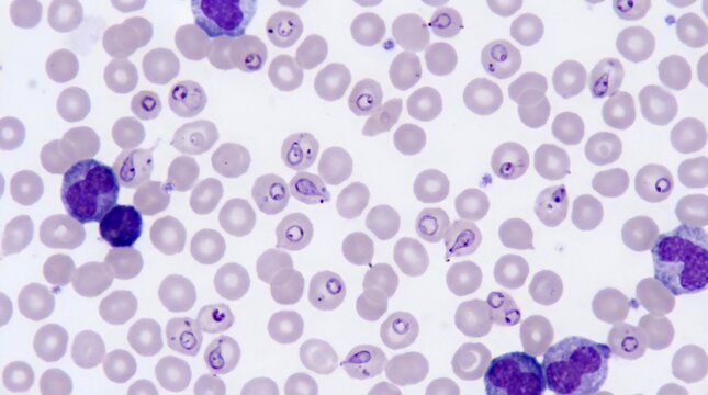 Microscopic View of Human Blood Smear Showing Malaria Parasites