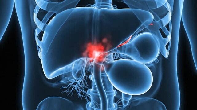 Medical Animation of Gallstones in the Human Body, Showing the Gallbladder and Bile Ducts, 3D