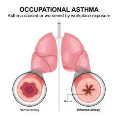 Occupational Asthma, Lungs Flashcard Poster