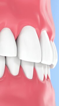 White teeth with bleeding gums closeup highlighting gum inflammation and oral treatment process, 3d render
