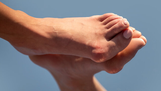 Hallux valgus deformity of big toe joint. Bare foot with Hallux valgus deformation. Human foot sole with deformities. Hallux Valgus on female legs close up. Feet of woman with hallux valgus.