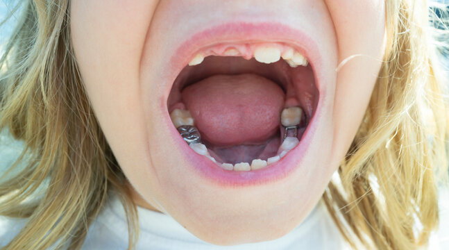 Child with tooth gap. Dental kid closeup mouth. New teeth growing. Toothless kids dental smile. Child losing teeth. Dental growth. Teeth baby care. Closeup child mouth. Dental treatment, kid caries.