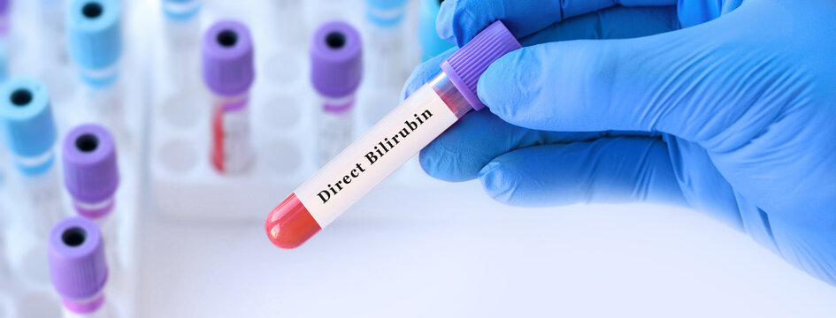 Doctor holding blood sample tube for direct bilirubin test, laboratory diagnostics of liver function, bile metabolism and jaundice detection in clinical medicine, medical analysis background