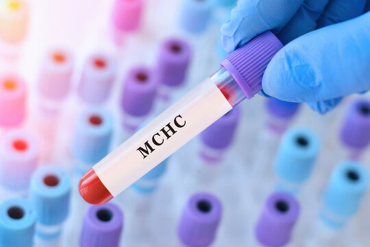 Doctor holding blood sample tube with MCHC test, mean corpuscular hemoglobin concentration analysis for anemia diagnosis, red blood cell quality evaluation and hemoglobin saturation assessment