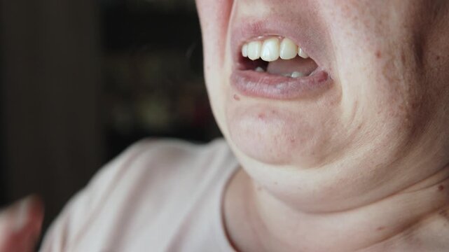 Caucasian woman grimacing and sneezing into hands, closeup. Person cringing mouth plus squeezing eyes shut and double chin. Body reaction to respiratory irritants.