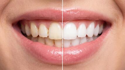 Close up of a female smile split in two halves showing the before and after results of a professional teeth whitening procedure. Perfect dental health and cosmetic dentistry concept.